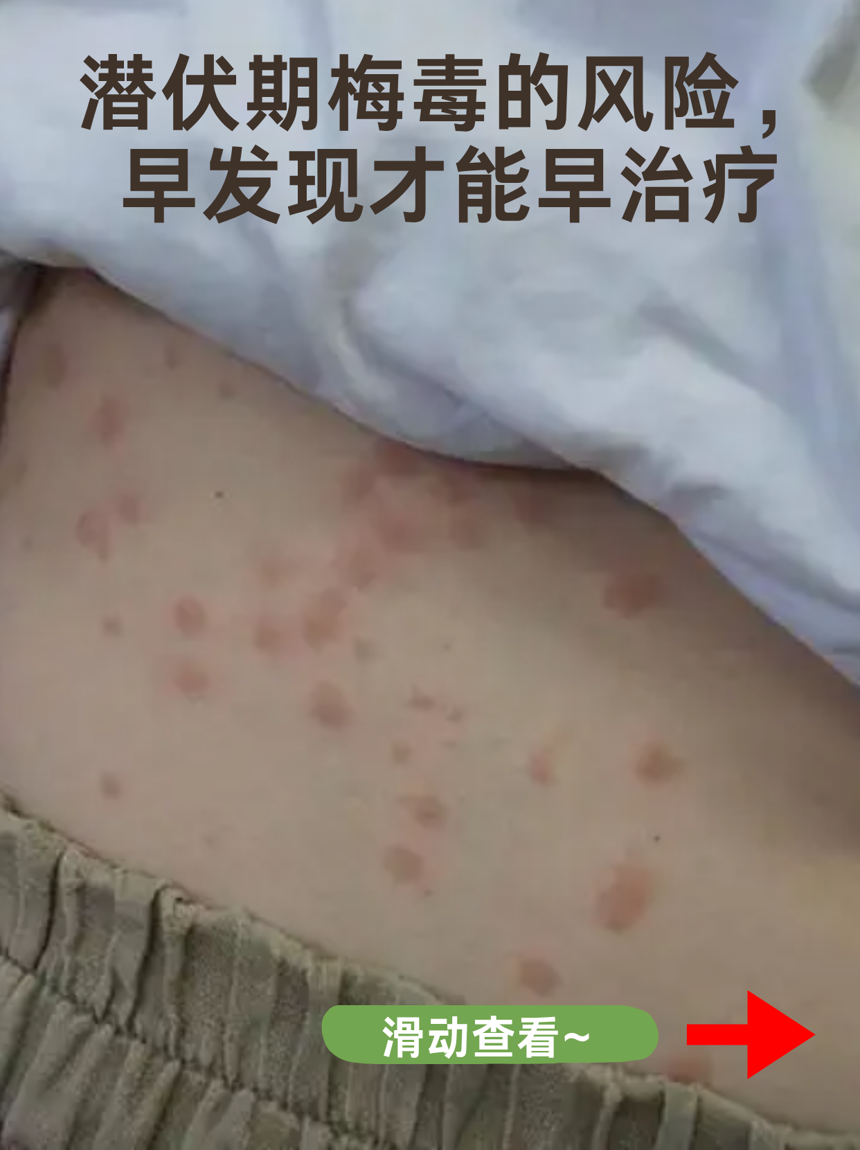 “德尔塔毒株或导致更严重疾病” 德尔塔毒株的临床症状？-第3张图片